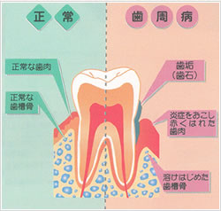 歯周病 やまぐち歯科クリニック